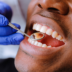 Full Mouth Reconstruction in Carmichael
