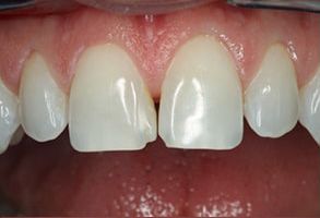 Redford Dental Care | All-on-6 reg , Dental Bridges and Veneers